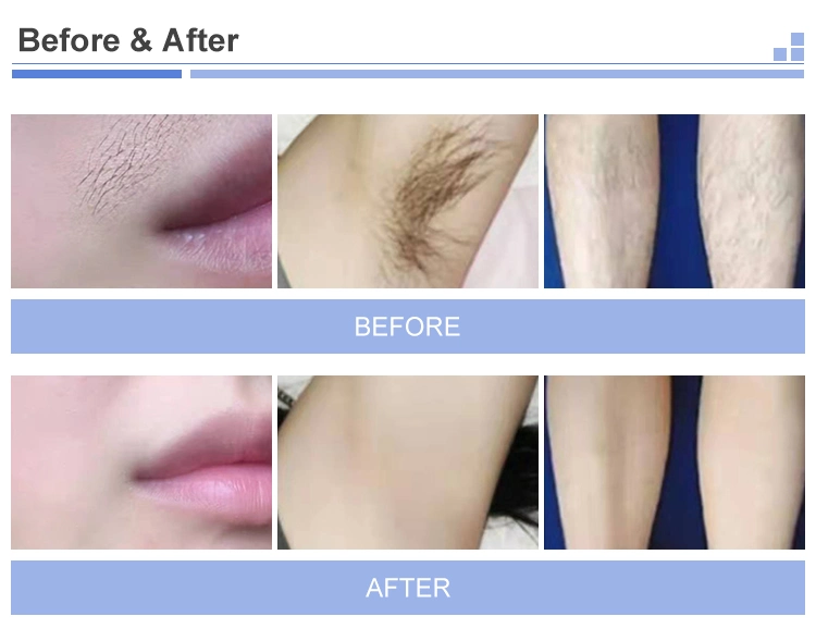 Diode Laser 755 808 1064 Laser Hair Removal